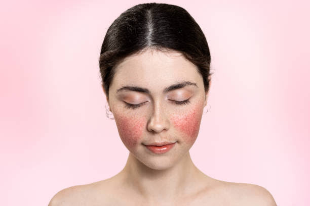 ROSACEA